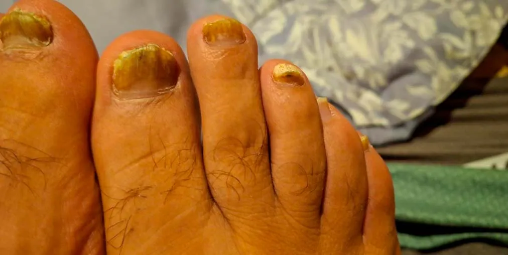 Psoriasis Ungueal Antes