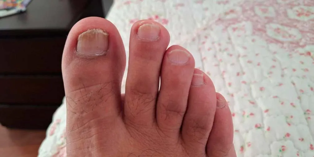 Psoriasis Ungueal Después