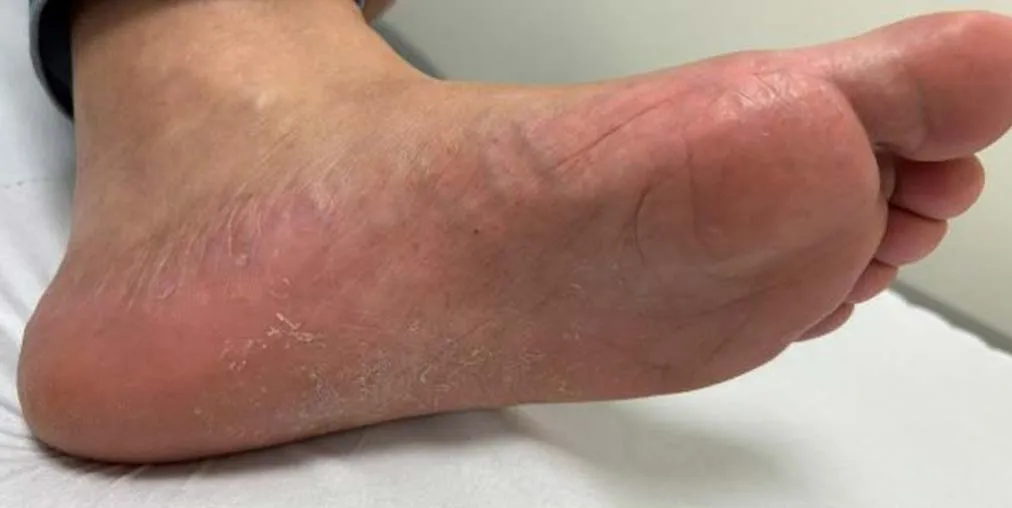 Psoriasis Palmoplantar Después