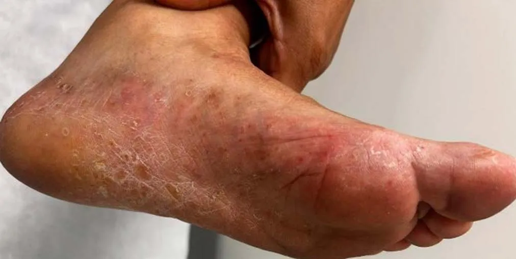 Psoriasis Palmoplantar Antes